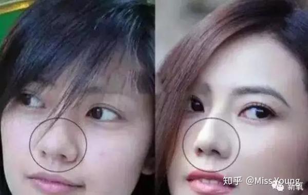 或者是鼻头,鼻翼缩小后微弱的鼻孔不对称,大家都不是365天无间歇被