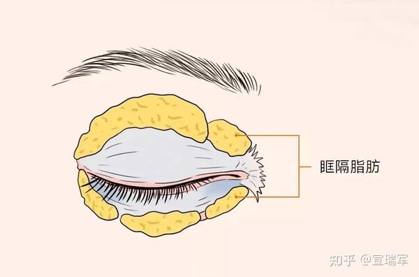 为什么医生不愿意把你的眼袋脂肪再多去点?