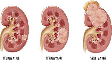 肾肿瘤需要了解的事