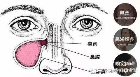 13,其他:有的患者鼻塞还可能为鼻瓣区狭窄,鼻翼下塌引起;小儿张口