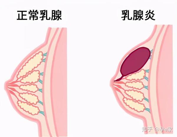 乳腺炎主要是乳汁堵塞,淤积造成的,是乳腺管周围的组织感