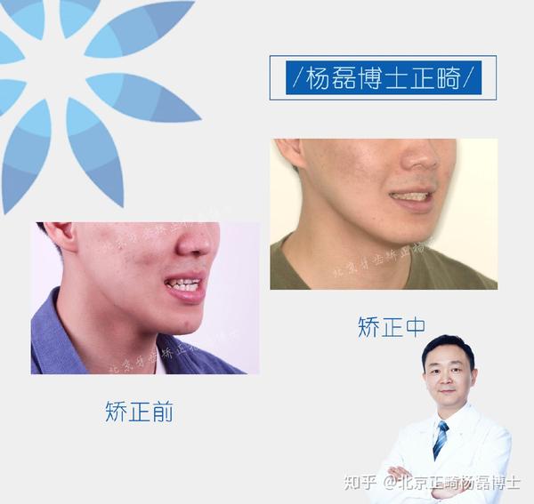 北京正畸杨磊博士:骨性反颌偏颌患者