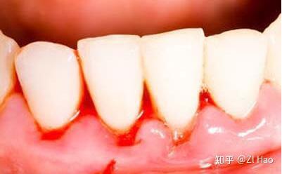 牙缝清洁到底有多重要?