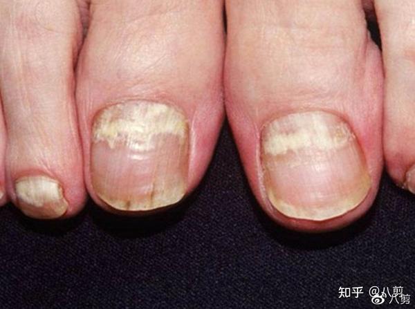 灰指甲——就是甲癣,也叫甲真菌病,是指由真菌引起的指(趾)甲感染.