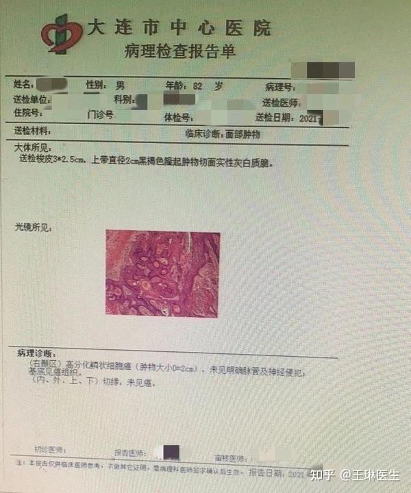 高分化的鳞状细胞癌,但是所有切缘一次性切除到位,符合扩大切除的范围