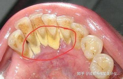 图为附着在牙齿内侧的食物残渣最终形成的牙齿污垢