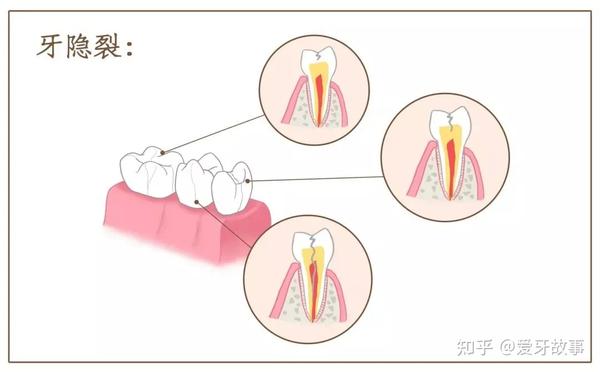 我们常说的"牙齿裂开",医学上称之为"牙隐裂",牙隐