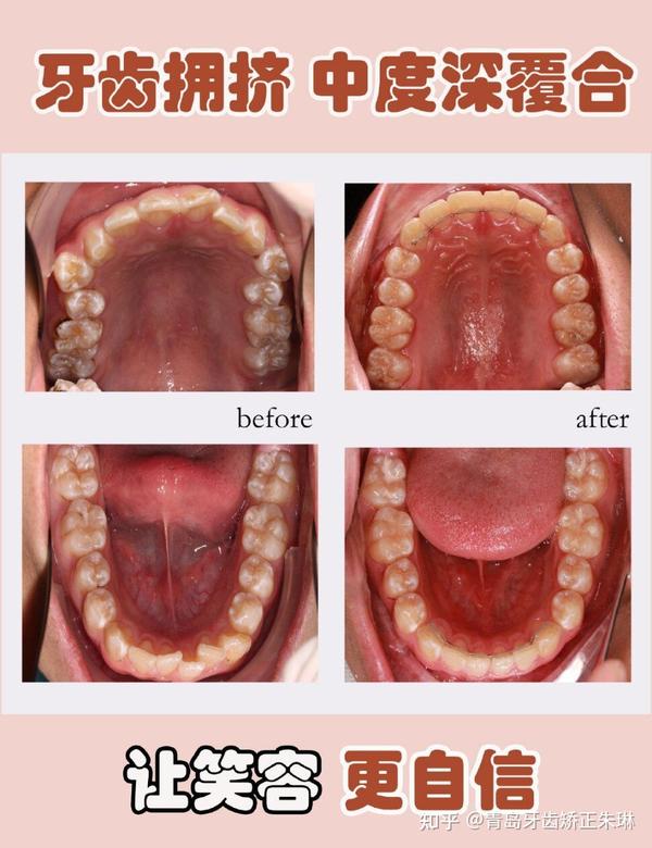 青岛牙齿矫正丨朱琳医生正畸改善面型案例合集(持续更新中)