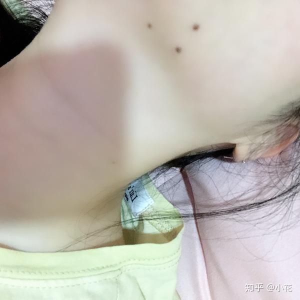 我是女生 下巴靠右边位子有三颗痣 还形成了一个三角形 觉得很奇怪 想