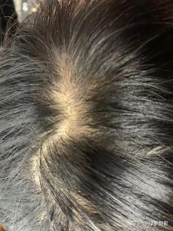 吃头发的后果?有点恶心,害怕勿进.(异食癖,父母要注意)