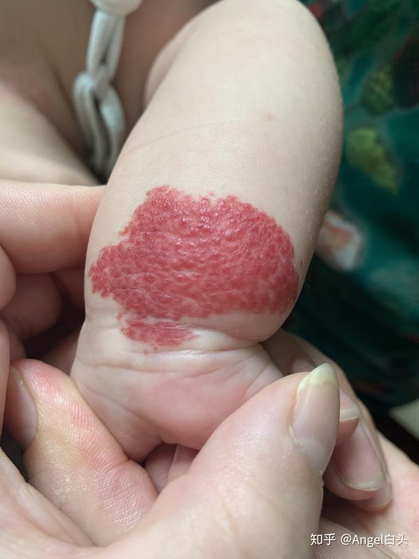 我们家宝贝是出院了才发现的血管瘤,刚开始浅浅的红色,月子里颜色越来
