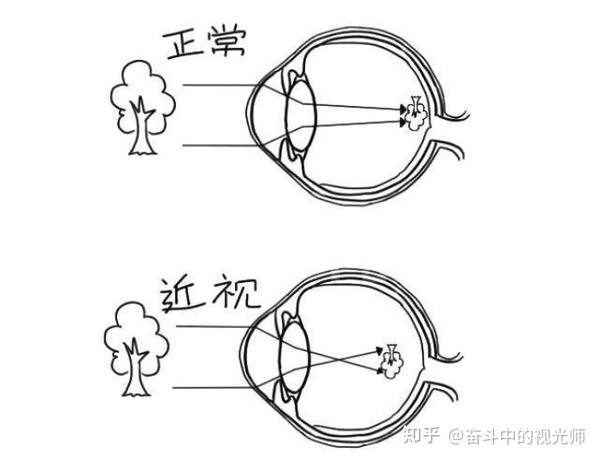 明白了我们人眼活动以及近视原理.