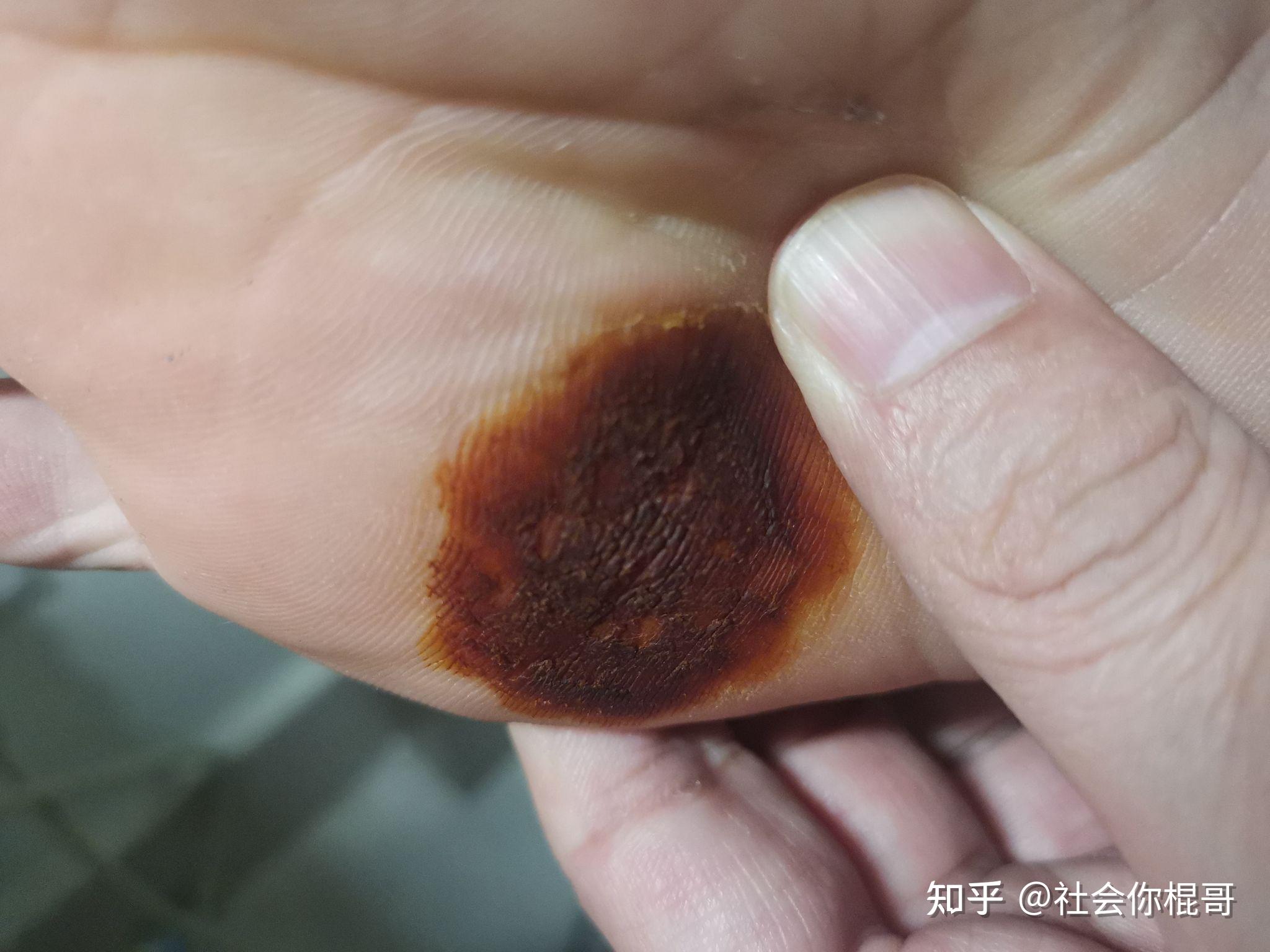 切身体会碘酊治疗重度跖疣