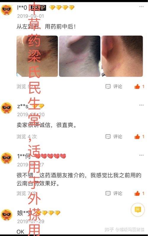 隐翅虫皮炎,隐翅虫蛰咬伤,有一方法,有特效