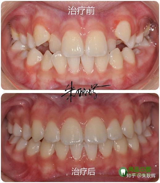 拥挤 ,牙齿重叠, 不便清洁,容易积存牙