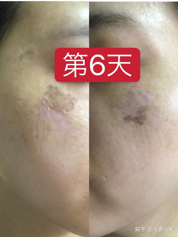 日记我在日本的皮肤诊所做了调q红宝石激光祛真皮斑adm持续更新中