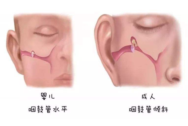 高烧哭闹耳朵剧痛警惕秋冬季节宝宝常见病中耳炎