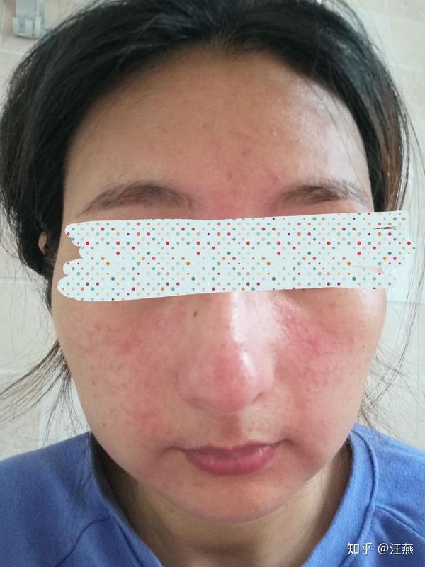 5月27号早上洗完脸,小白疹子基本已经枯了,脸上还是红,有点痒