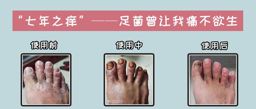 【孙叔公】"七年之痒"——足菌曾让我痛不欲生