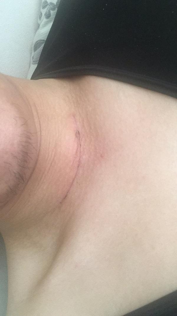 老公旁边的病人是做了甲状腺全切的,做了气管切开,医生也找了我谈话.