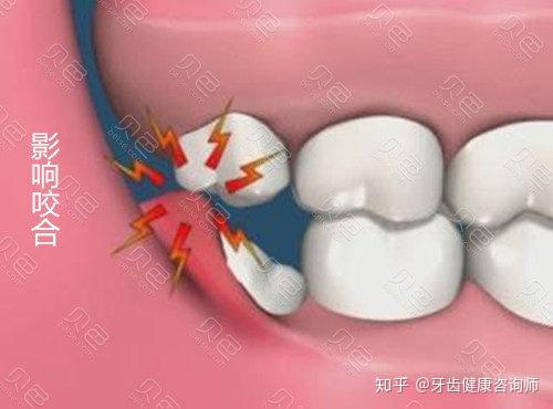 如何判断自己是否长了智齿?智齿是不是一定要拔掉?