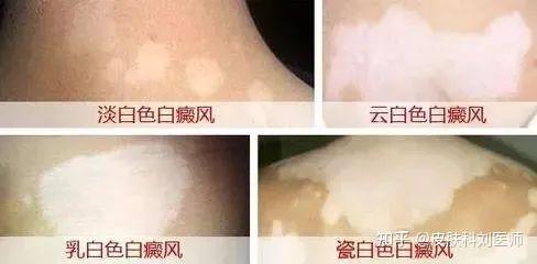 肤康科普白斑扩散防不胜防抓住这几个征兆让你及时察觉白斑变化