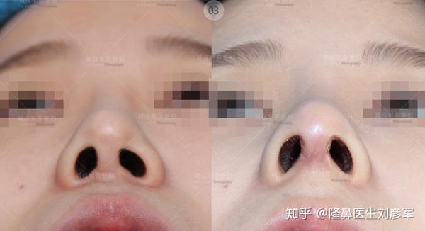 就是鼻孔的大小不一,这种鼻孔整形手术方法:有鼻唇沟皮瓣z形成形术,双