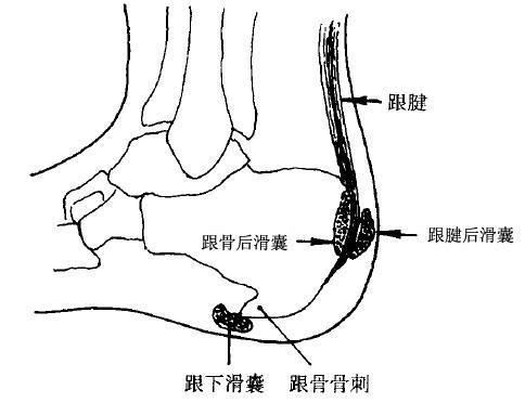 跟骨后滑囊炎的治疗