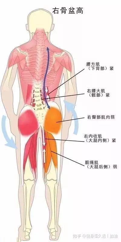 原因:长短腿,腰方肌和背阔肌过度收缩;单侧的髂骨前旋或者后旋,骶髂