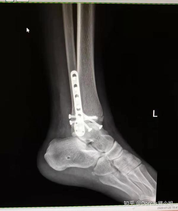 医生很负责,关照术后不能吃太油腻的,3小时后方可正常进食.