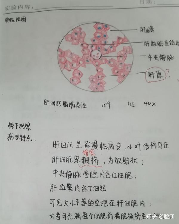 肝细胞脂肪变性 混合血栓 肝脓肿 淋巴结结合 原发性肝细胞癌