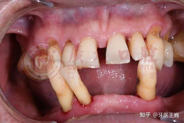 术前,下颌牙齿只剩3颗,牙根暴露,牙龈萎缩严重