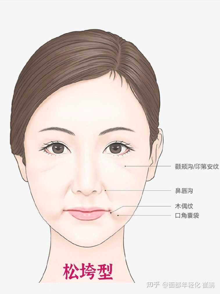 面部软组织下垂明显,存在印第安纹(颧颊沟,法令纹(鼻唇沟,木偶纹