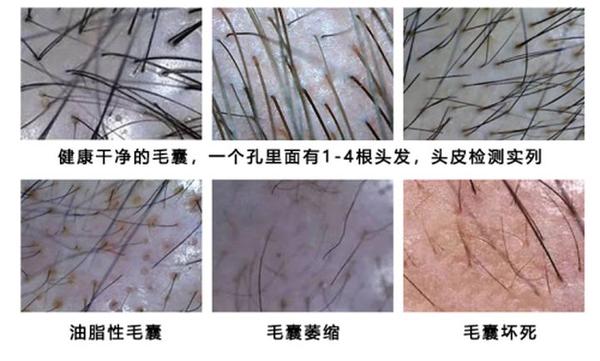 其次,通过深层毛囊检测能够清楚的观察到头皮的生长环境,毛囊的健康