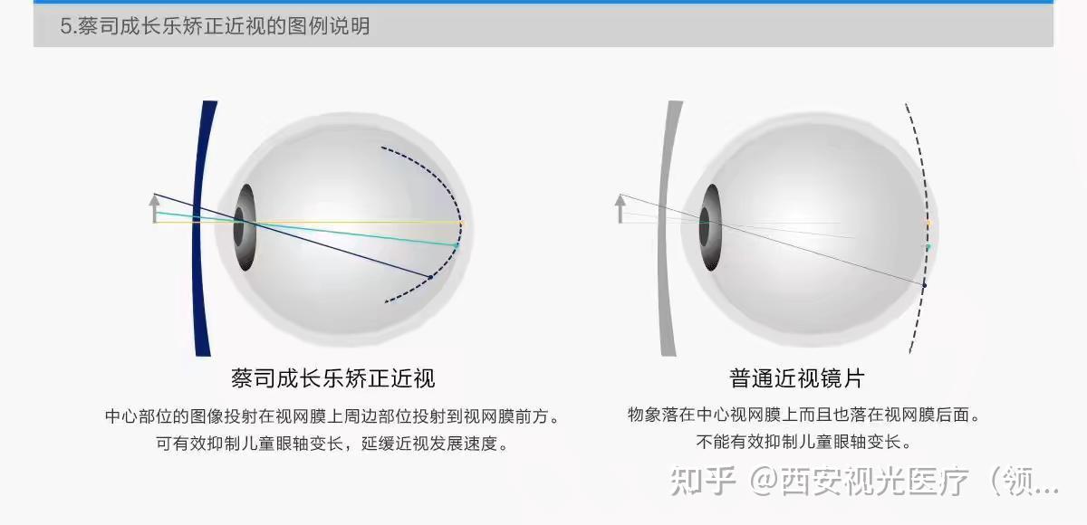 成长乐,属于蔡司品牌,树脂镜片,分为三个系列:5.周边离焦镜片.