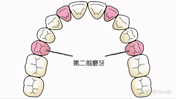 上颌第二前磨牙vi型根管配置