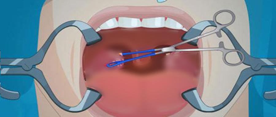 舌咽,耳根部疼痛可能是舌咽神经痛导致