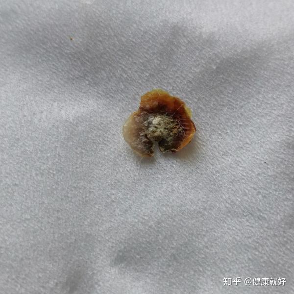 这是今天12月4号用双氧水敷了2小时掉了的疣体