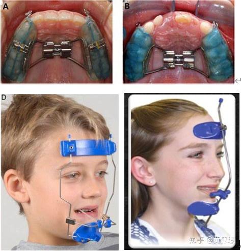 前方牵引(嘴巴里的装置根据牙齿萌出的情况可能会不一样,不一定都是图