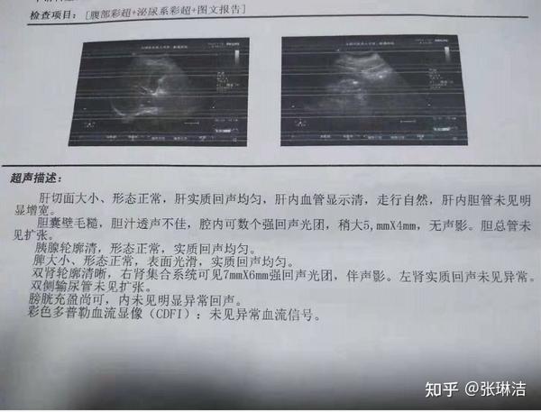 胆囊息肉的康复过程!