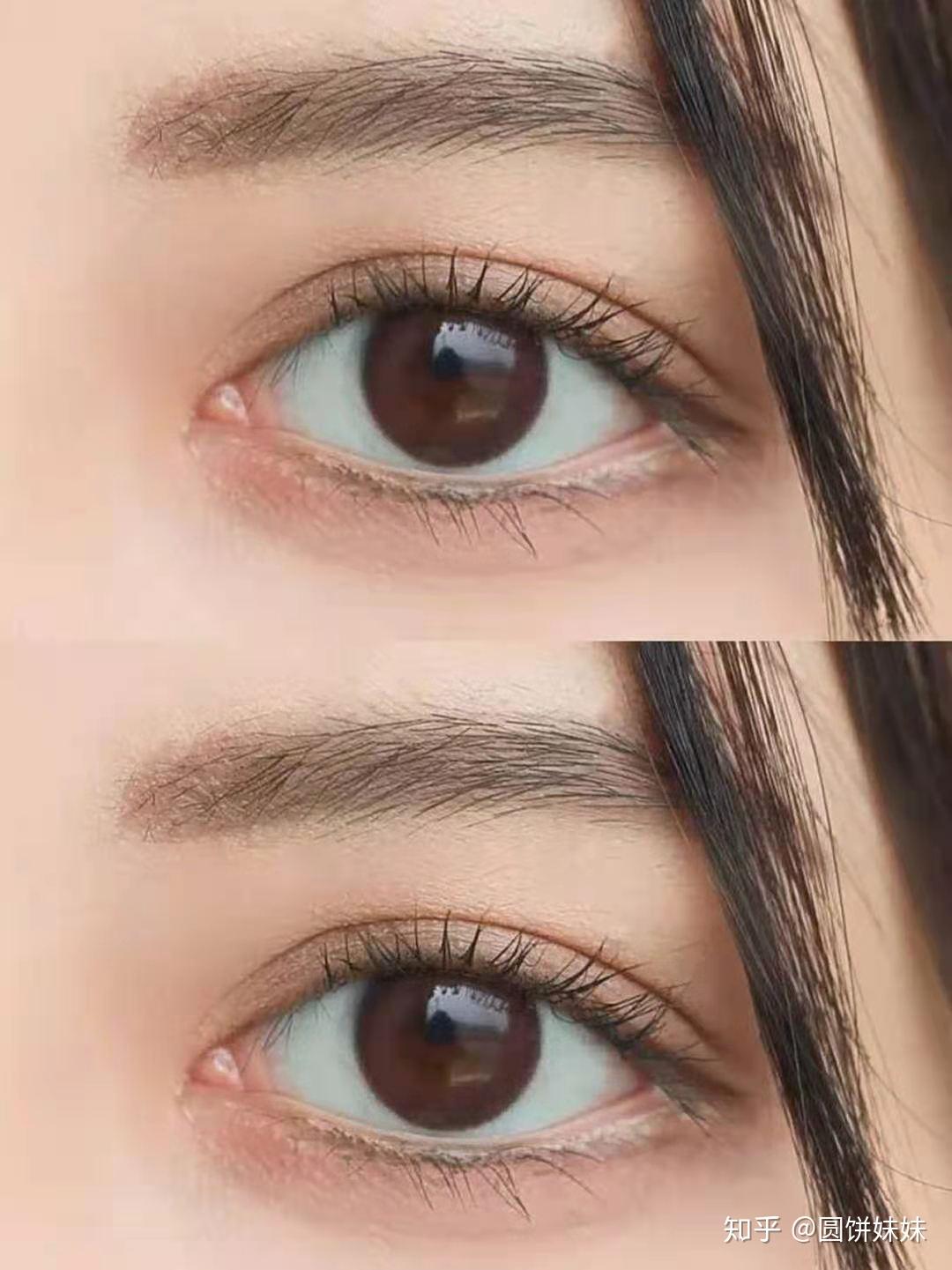 成都全切双眼皮,我这双眼皮能当你们问医森的模板不?