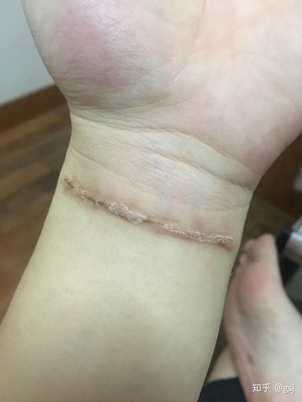 记录纹身切除后的恢复情况