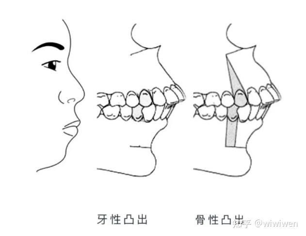 一般分为二大类, 牙性前突,骨性前突(还有一种是牙性伴骨性)