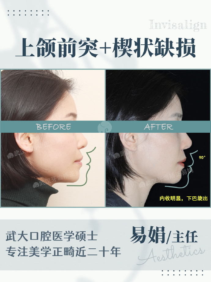 武汉牙齿矫正嘴凸深覆合如何预防楔状缺损