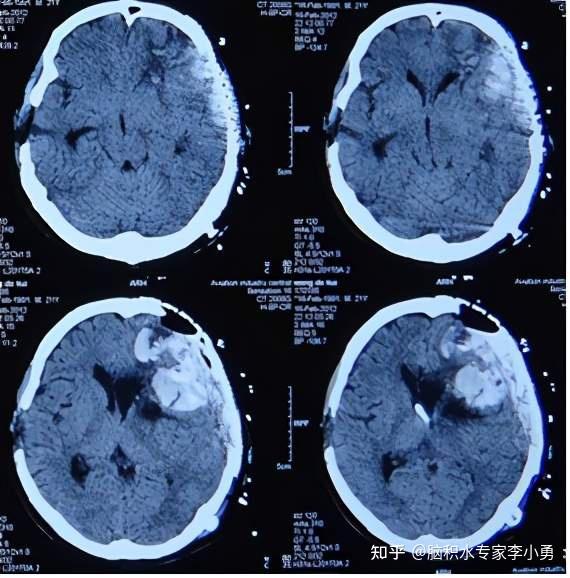 "明星"发型师车祸开颅术后脑膨出及脑室分流后脑内陷偏瘫,因在李小勇