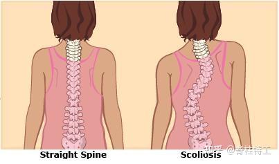 脊柱侧弯应该避免的动作与姿势
