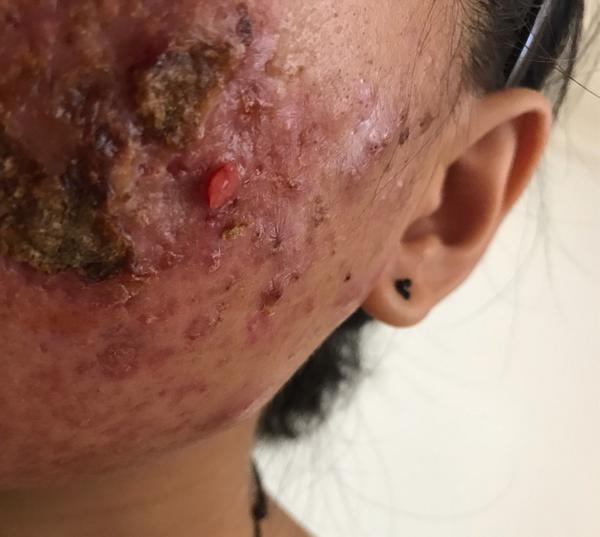 201911更新来了超级严重痤疮和痘坑痘印疤痕的治疗过程记录多图异常