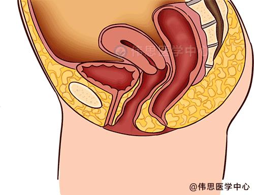 03阴道穹隆膨出直肠膨出常与前骨盆松弛相关联,往往引起膀胱膨出和