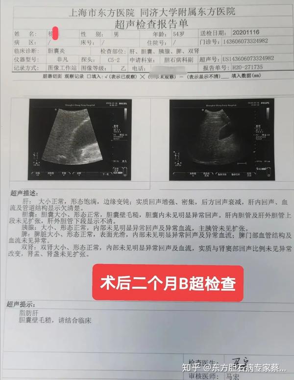 胆囊结石胆囊炎药物治疗效果差最终还是要手术治疗可以考虑保胆取石