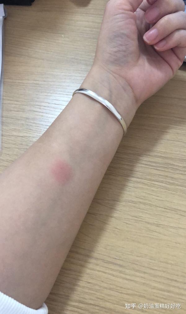 接着抽血化验做留痰结痰菌做ppd皮试,告知我回家吧,72小时再过来.